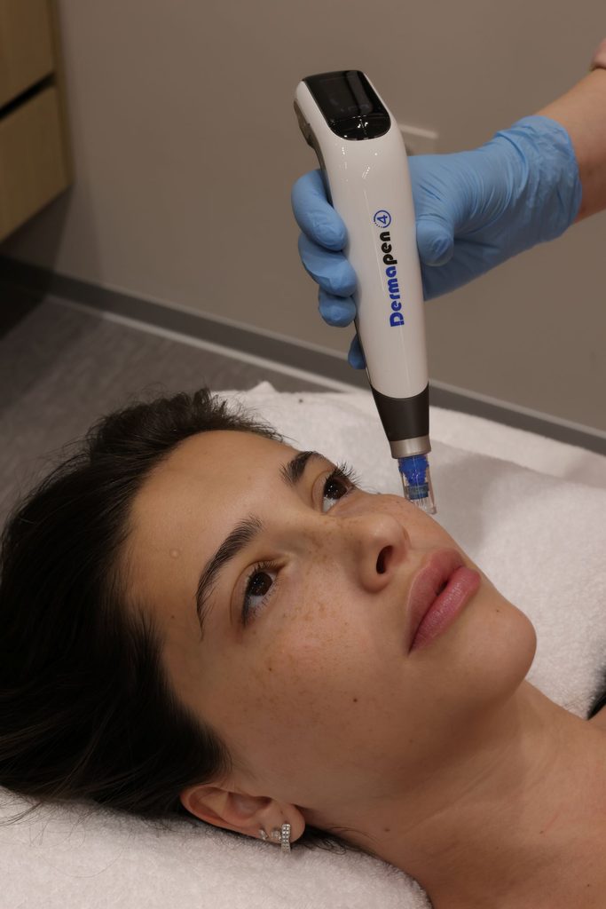 Dermapen 4 Microneedling Treatment in Tirana