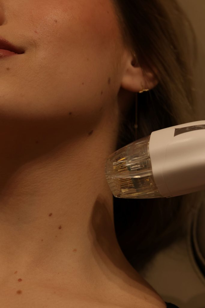 virtue rf microneedling