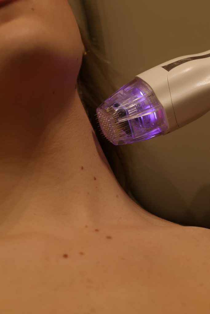 virtue rf microneedling treatment