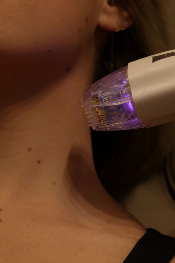virtue rf microneedling treatment